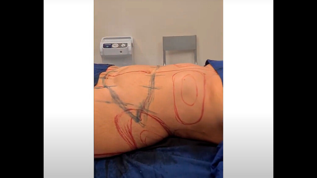 Beneficios de la Lipotransferencia 1 Imagen video 3