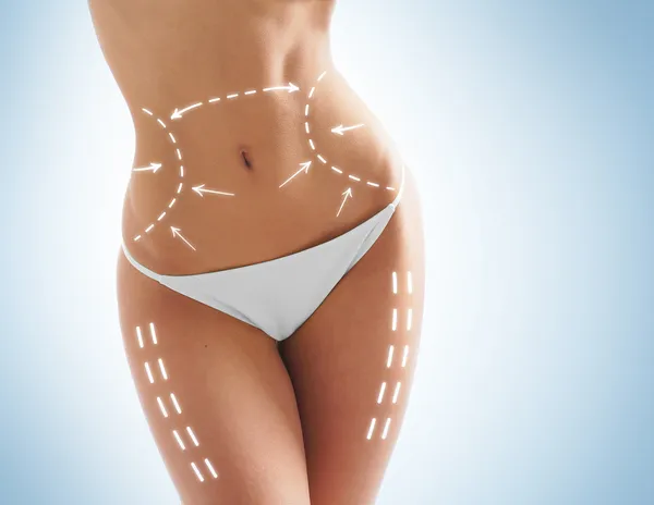 Descubre los beneficios más importantes de la liposucción y cómo puede mejorar tu vida 6 cirugia plastica