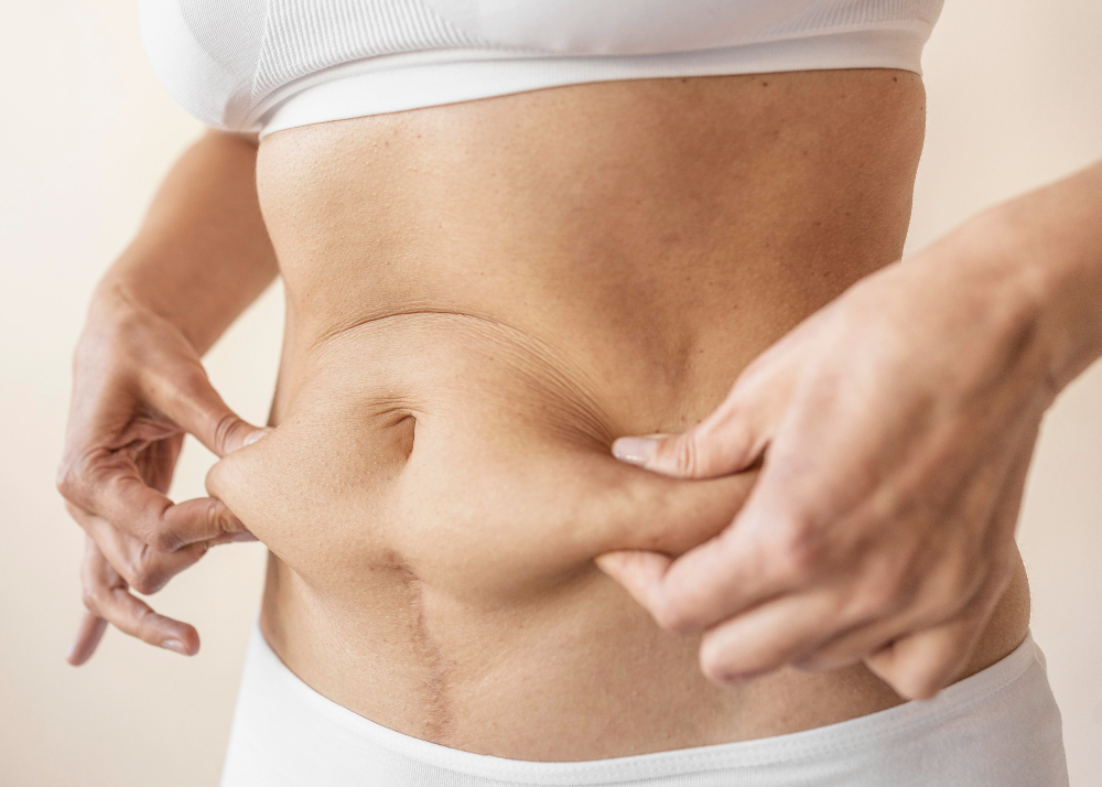Descubre los beneficios más importantes de la liposucción y cómo puede mejorar tu vida 3 cirugia