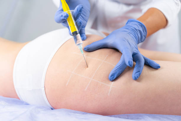 Beneficios de la Lipotransferencia 2 lipotransferencia en gluteos