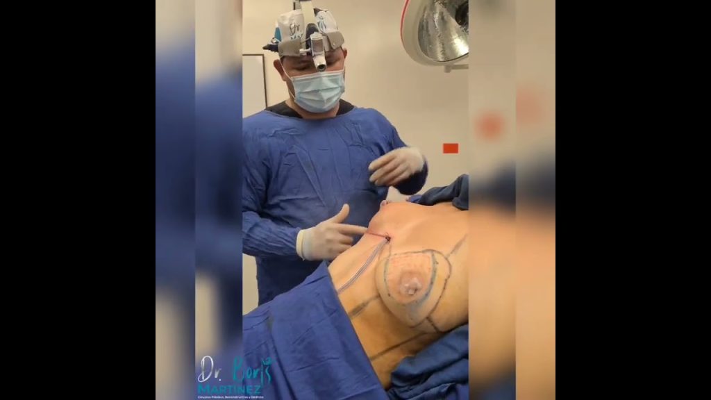 Beneficios de la Lipotransferencia 3 mastopexia y reduccion mamaria l