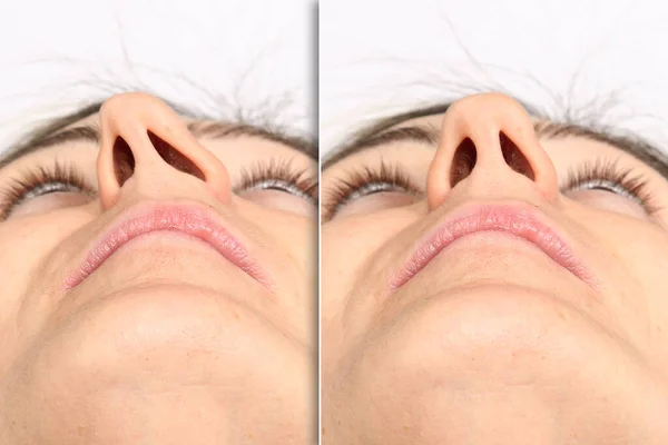 rinoplastia 1