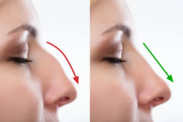 Consejos para una Recuperación Efectiva Después de la Rinoplastia 1 rinoplastia