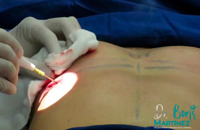 Descubre los Principales Beneficios de la Lipoescultura 6 testimonios 4