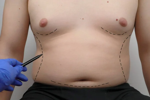 abdominoplastia