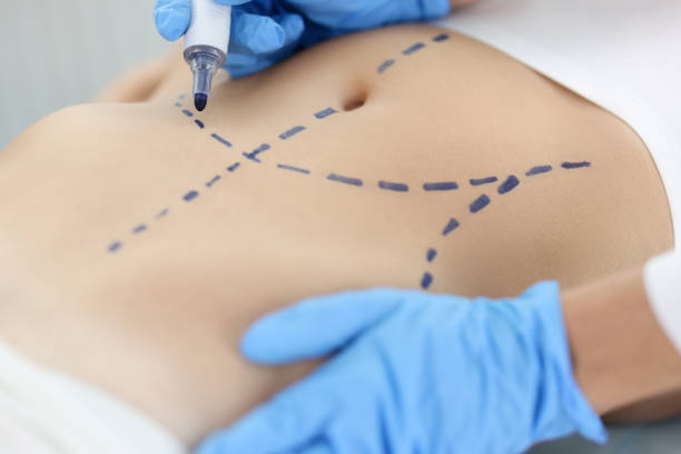 cirugia lipoescultura