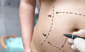 preparando la zona para una cirugia plastica abdominoplastia