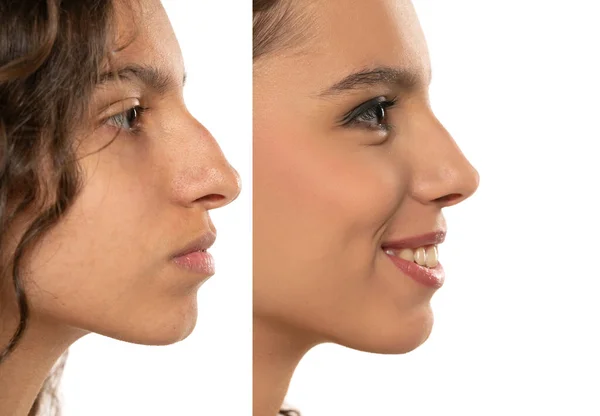 rinoplastea